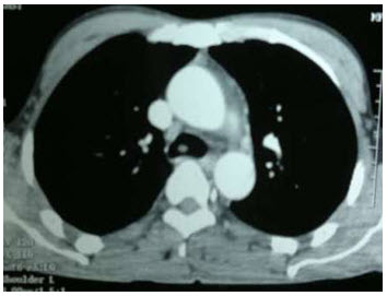 another_frame_of_ct_scan_showing_tumor