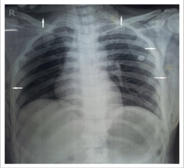 chest_x-ray_showing_air_in_subcutaneous_tissues_(white arrows)