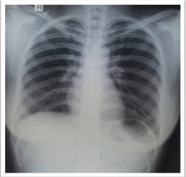 chest_x-ray_showing_complete_resolution_of_emphysema