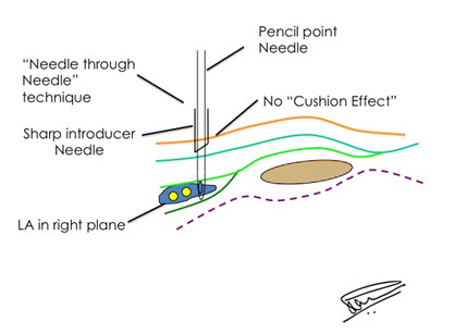 needle_through_needle_for_eliminating_“cushion_effect”_for_correct_needle_tip_placement