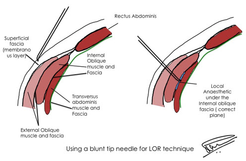 using_a_blunt_tip_needle_for_LOR_technique
