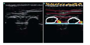Acoustic- shadowing in-a lung-ultrasound