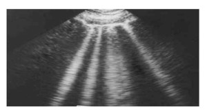 Comet tail artifact- Ultrasound -of- lung- showing- Comet