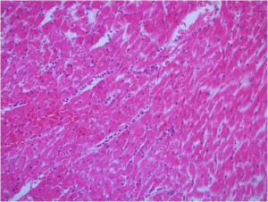 Extensive- inflammatory- cell- infiltration- and -edeme -of -myocardial- tissue- in- the- diabetic- ischemia- reperfusion -group, H&E x200