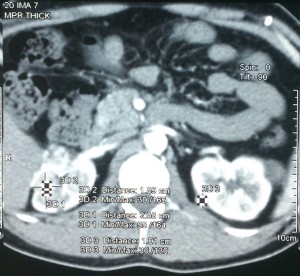 Computed tomography of abdomen-revealed bilateral -renal-masses