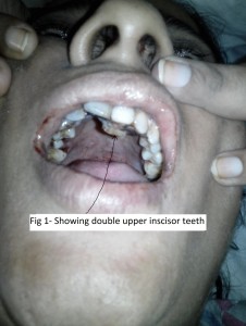 Double-row-of-upper-incisors