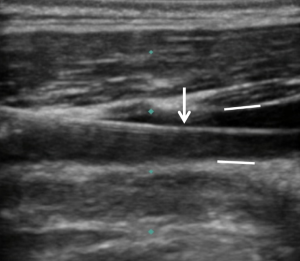 Longitudinal-ultrasound-image-of-the-neck