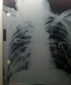 X-ray chest PA view-showing-metallic-stylet