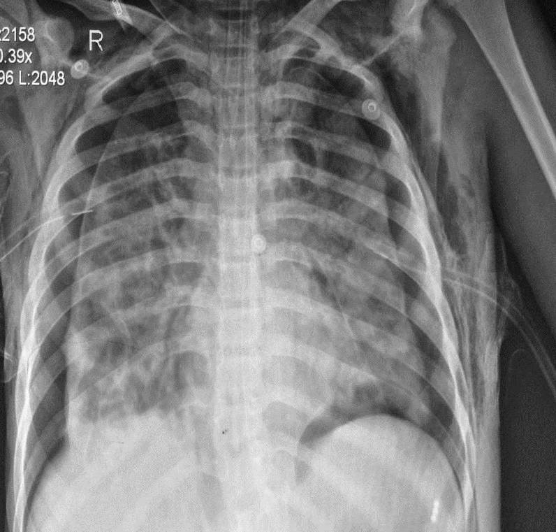 Bilateral pneumothorax complicating-figure-3