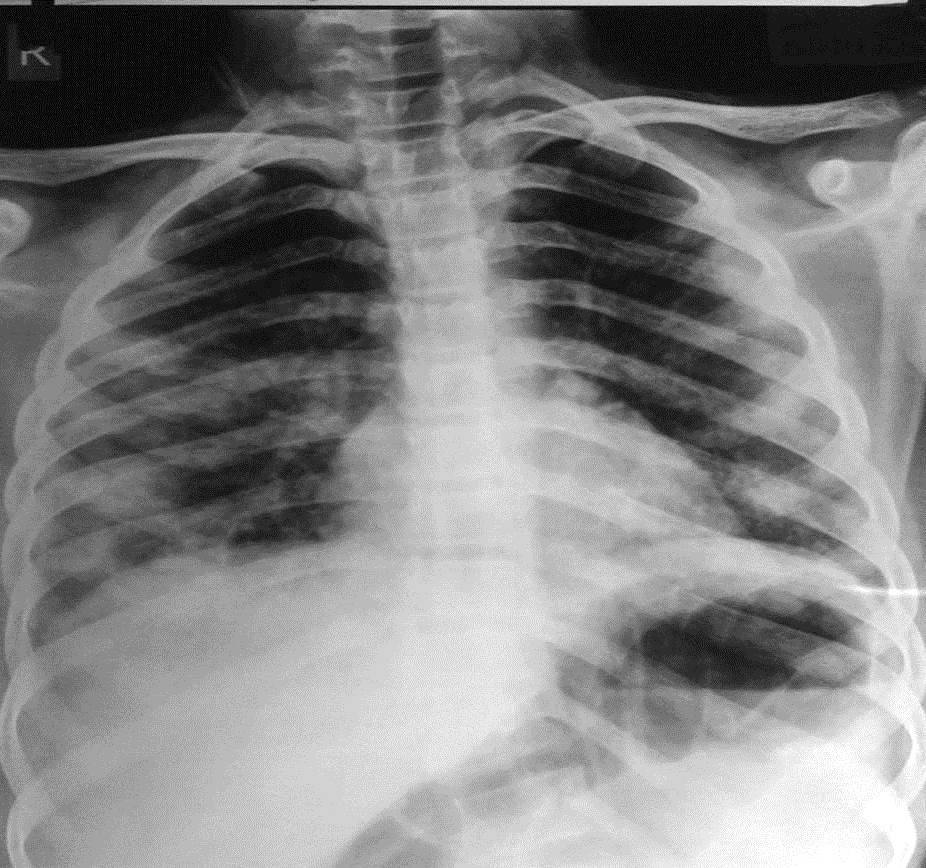CXR on admission; bilateral multilobar patchy infiltrates-figure-1