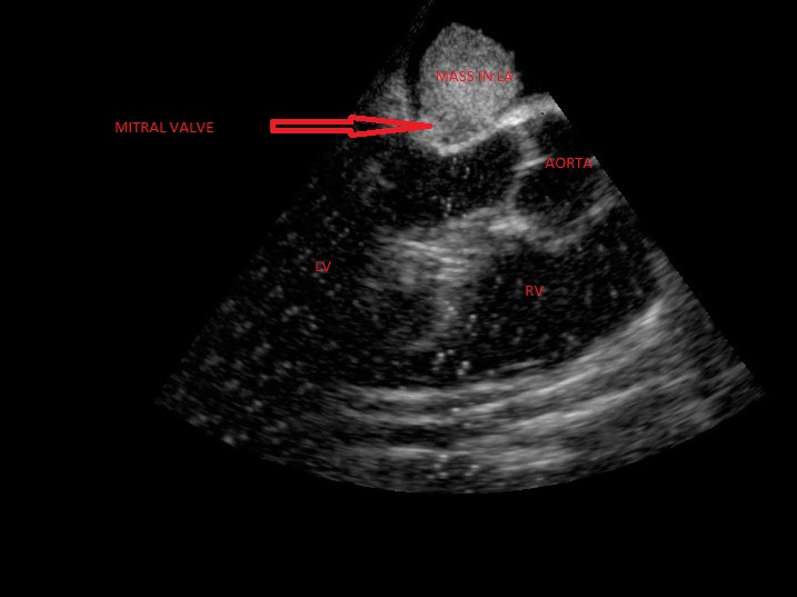Showing atrial mass above mitral valve-figure-1