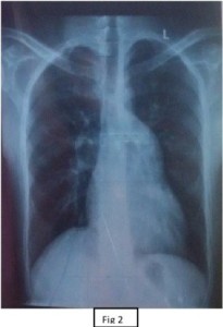 chest-x-ray-showing-left-figure-2