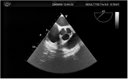 introduction-to-basic-transesophageal-echocardiography-tee-and-standard-viewsimage-1