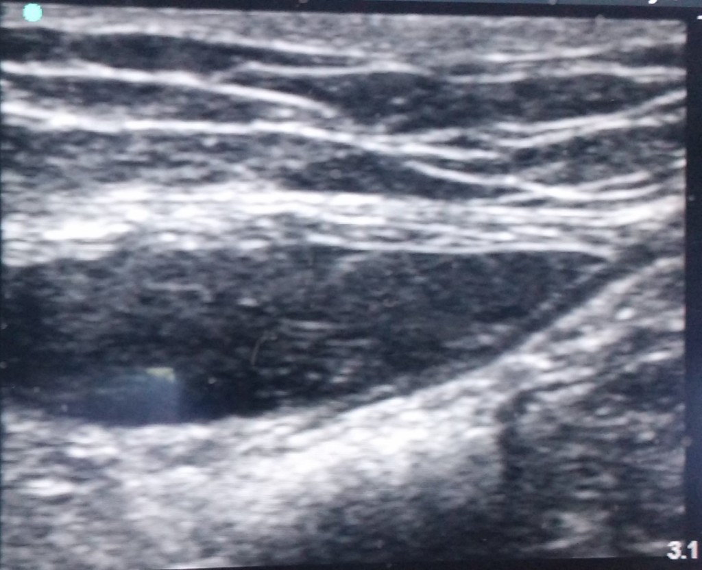 6Ultrasound guided abdominal-Fig-