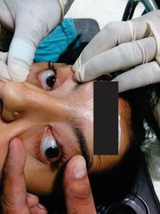 Blue-colored-sclera-in-OI-225x300.jpg