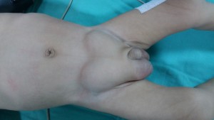 Love-sign’-hernia-bilateral-inguinal-3