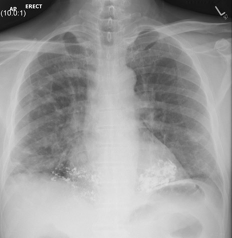 Pulmonary calcification or…? – Anaesthesia, Pain & Intensive Care